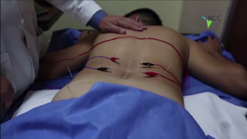 La acupuntura trasciende en Ecuador