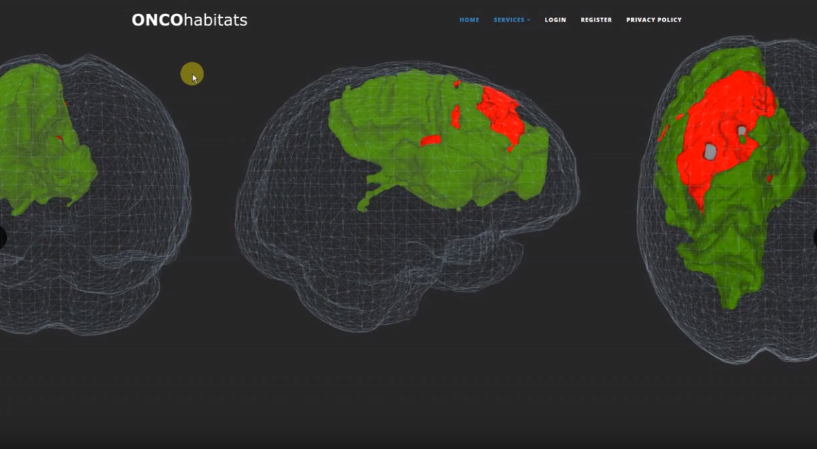 Una plataforma permite darle seguimiento a los pacientes con tumor cerebral