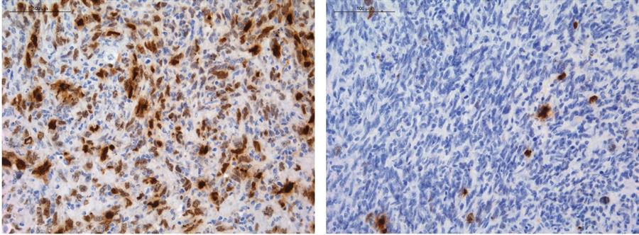 Descubren cómo algunos tumores cerebrales «esquivan» la quimioterapia