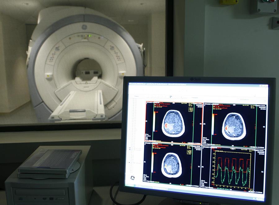 Descubren una nueva alteración en el cerebro de las personas con alzheimer