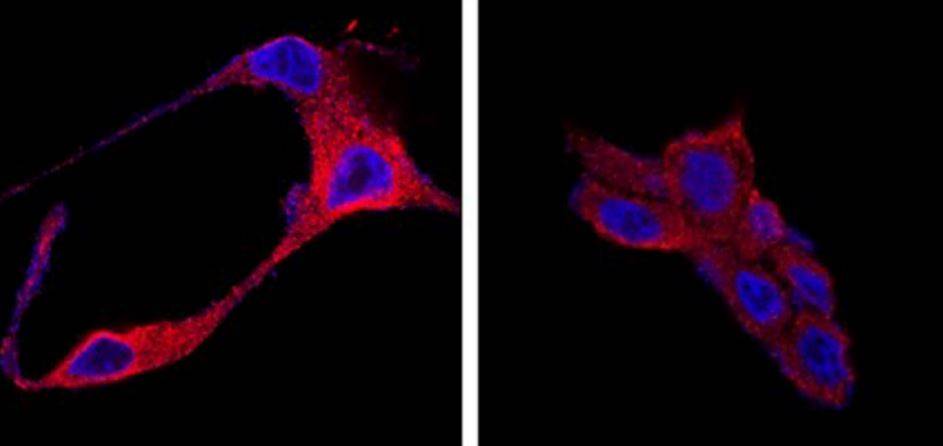 Usan nanopartículas para destruir células tumorales del cáncer de próstata