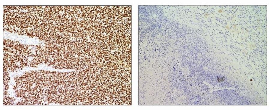 Utilizan el sistema CRISPR para eliminar células tumorales sin tocar a las sanas