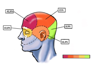 zonas-con-dolor-de-cabeza