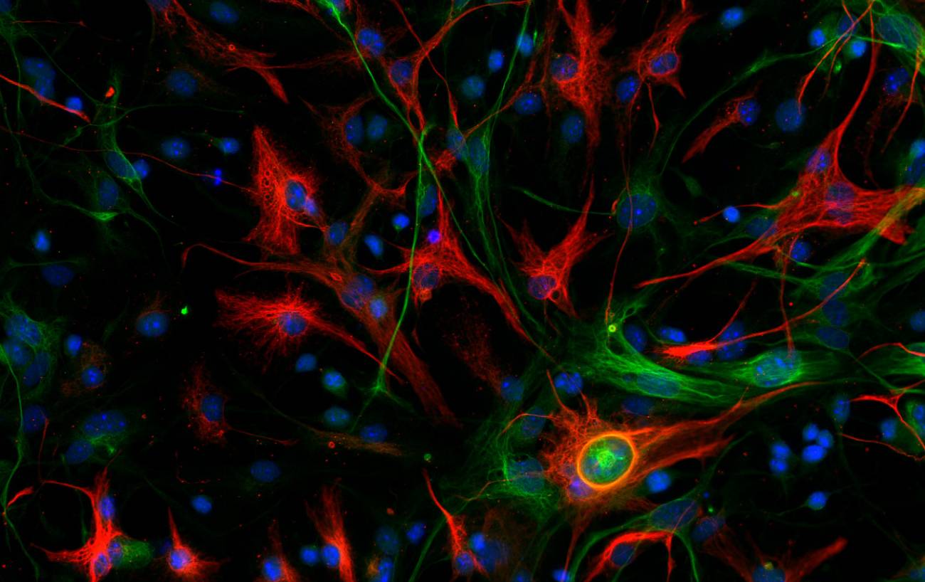 Descubierto un nuevo gen del cáncer cerebral con peor pronóstico