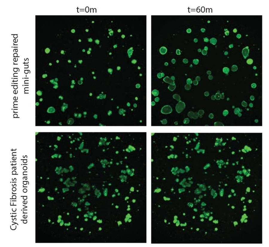 Corrigen mediante edición genética la fibrosis quística en organoides