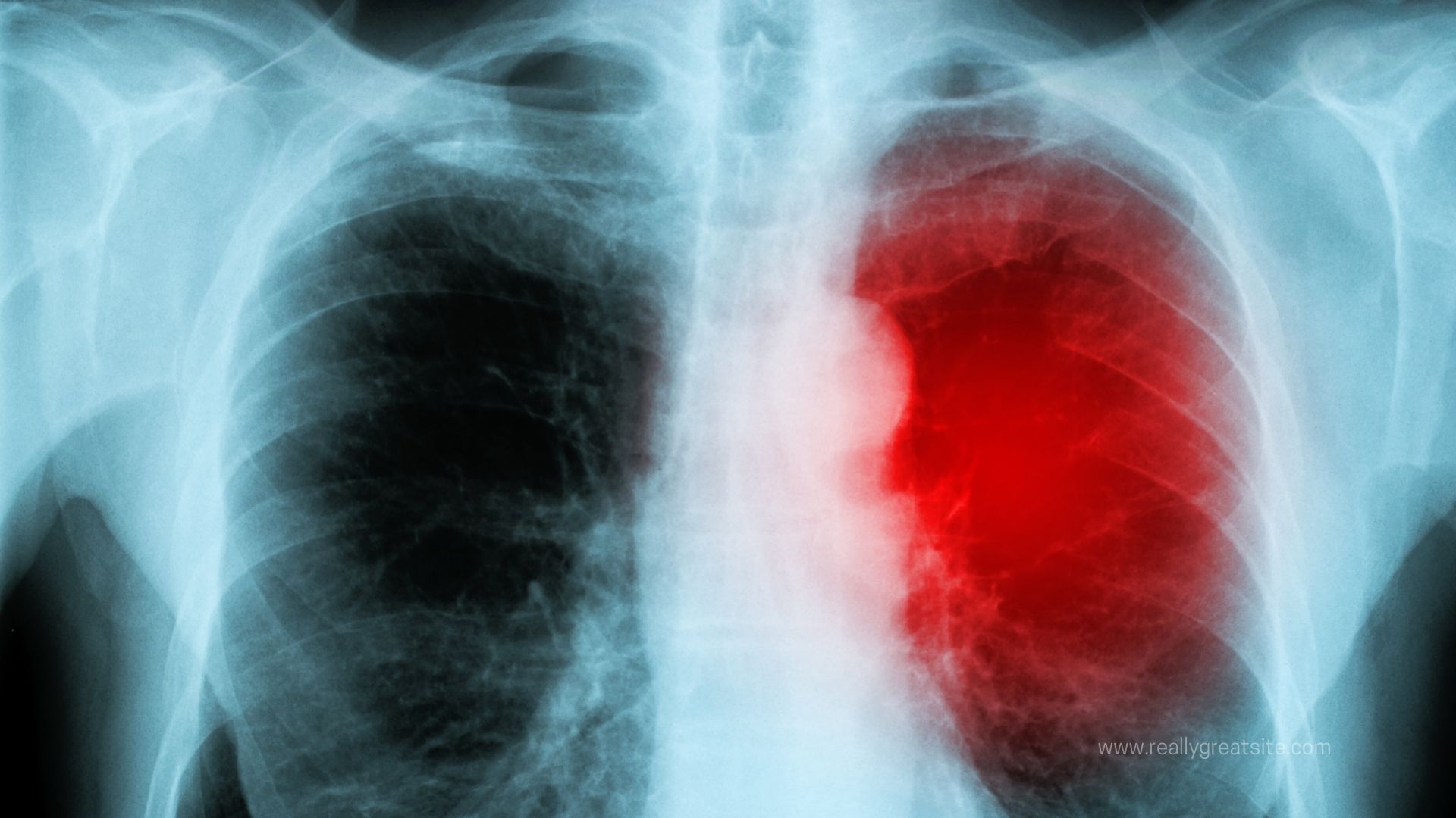 La miocarditis no es un efecto significativo de las vacunas, pero de COVID-19, sí