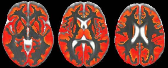 Una nueva resonancia permitirá anticipar patologías neurodegenerativas