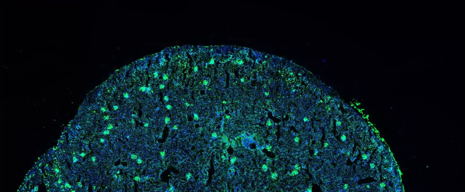 Identifican un nuevo marcador para el lupus