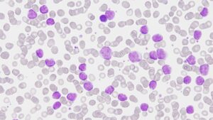 Completado-el-mapa-genomico-de-la-leucemia-linfatica-cronica