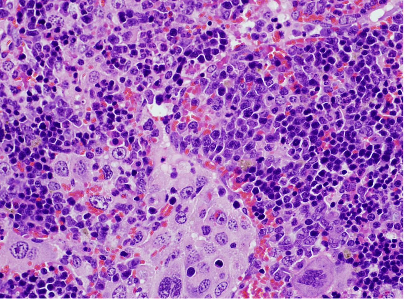 Una mutación genética clave en la aparición de linfomas y en el cáncer de pulmón