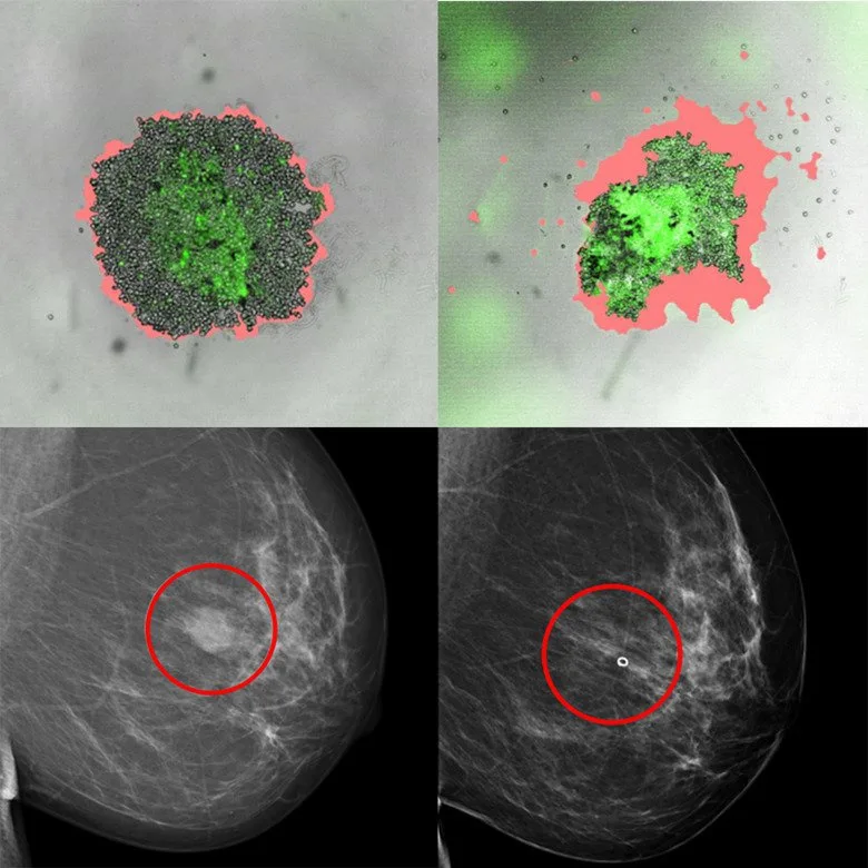 Cáncer de mama: nuevo método para buscar el mejor fármaco para cada paciente