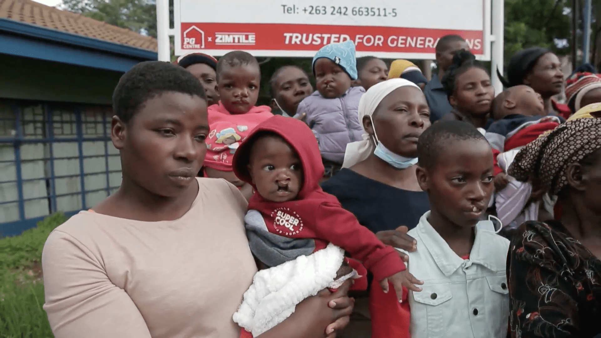 Labio leporino en niños: un estigma social que buscan revertir en Zimbabue