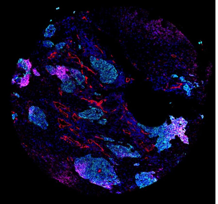 El mapa más amplio del cáncer de pulmón pone el foco en la diversidad tumoral