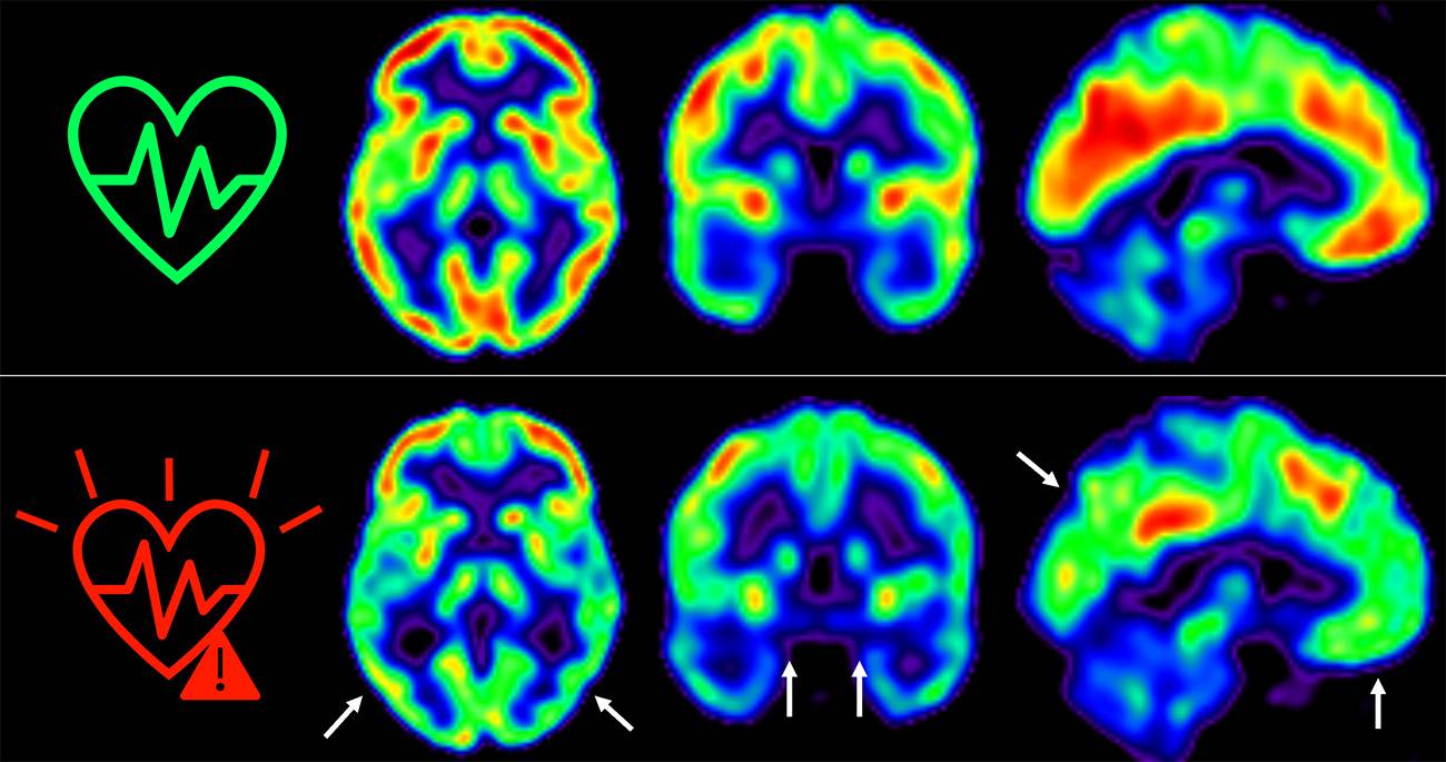 Cuanto antes controlemos los factores de riesgo cardiovascular, mejor para nuestro cerebro