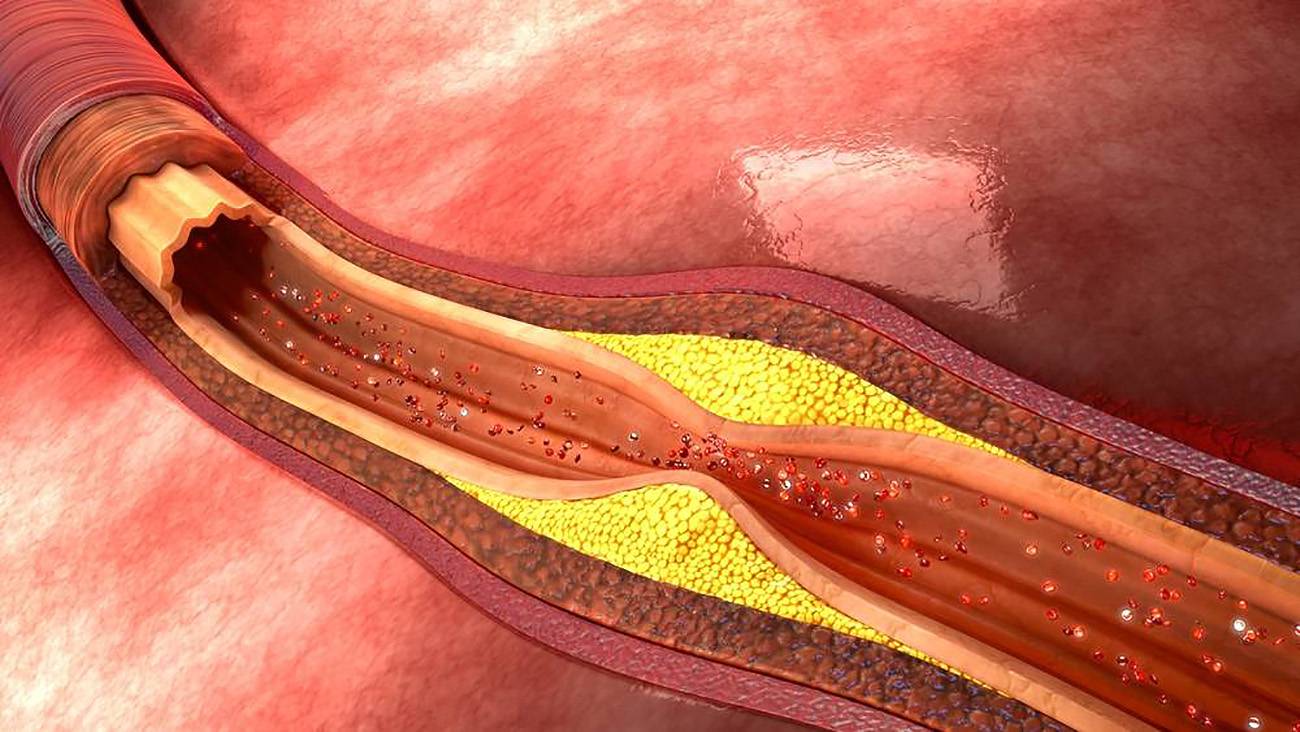 Nanopartículas de carbonato cálcico para mejorar el diagnóstico de la aterosclerosis