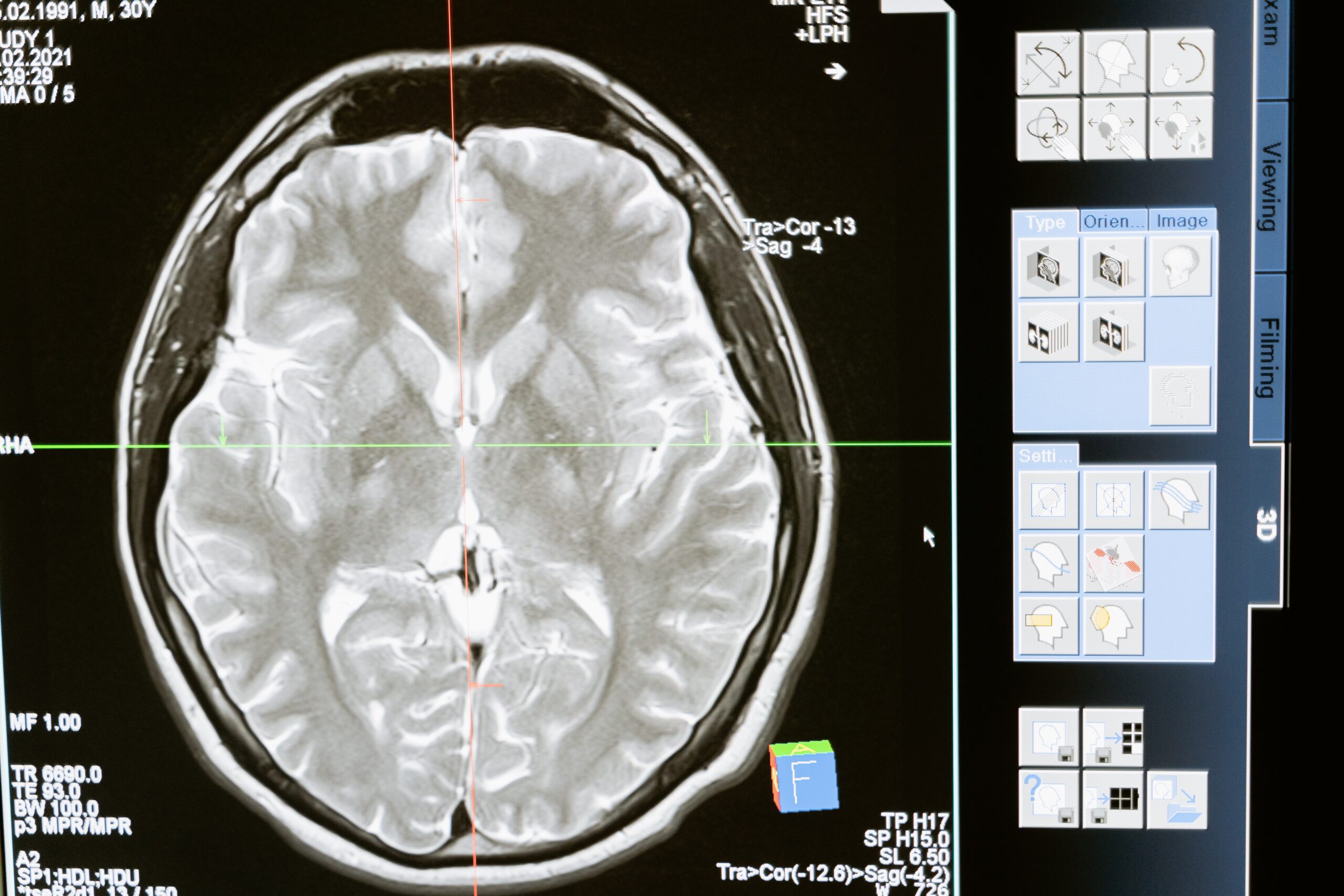 Descubren un nuevo tipo de células del cerebro con grandes perspectivas de investigación