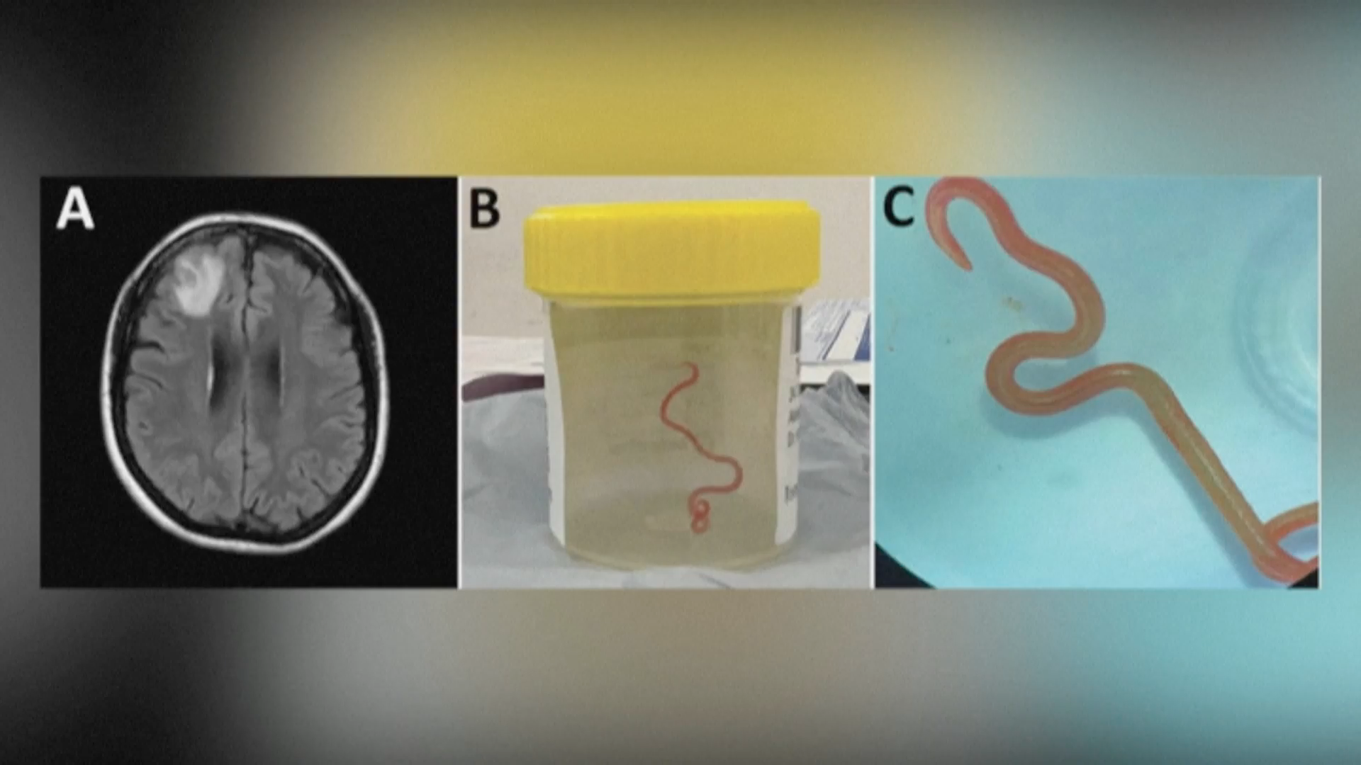 Médicos hallan por primera vez una lombriz parásita en cerebro humano