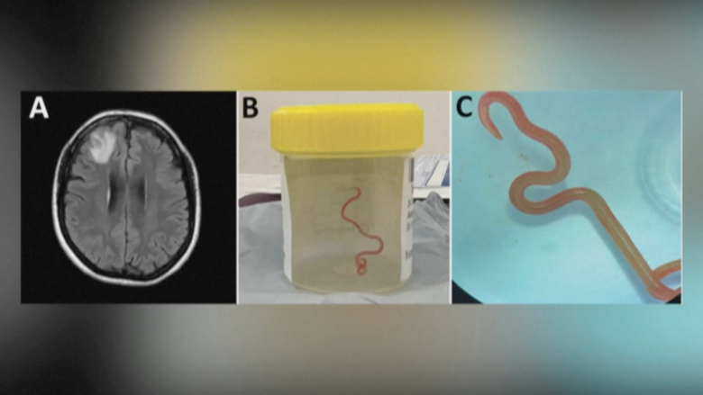 Un parásito de ocho centímetros en el cerebro de una mujer australiana