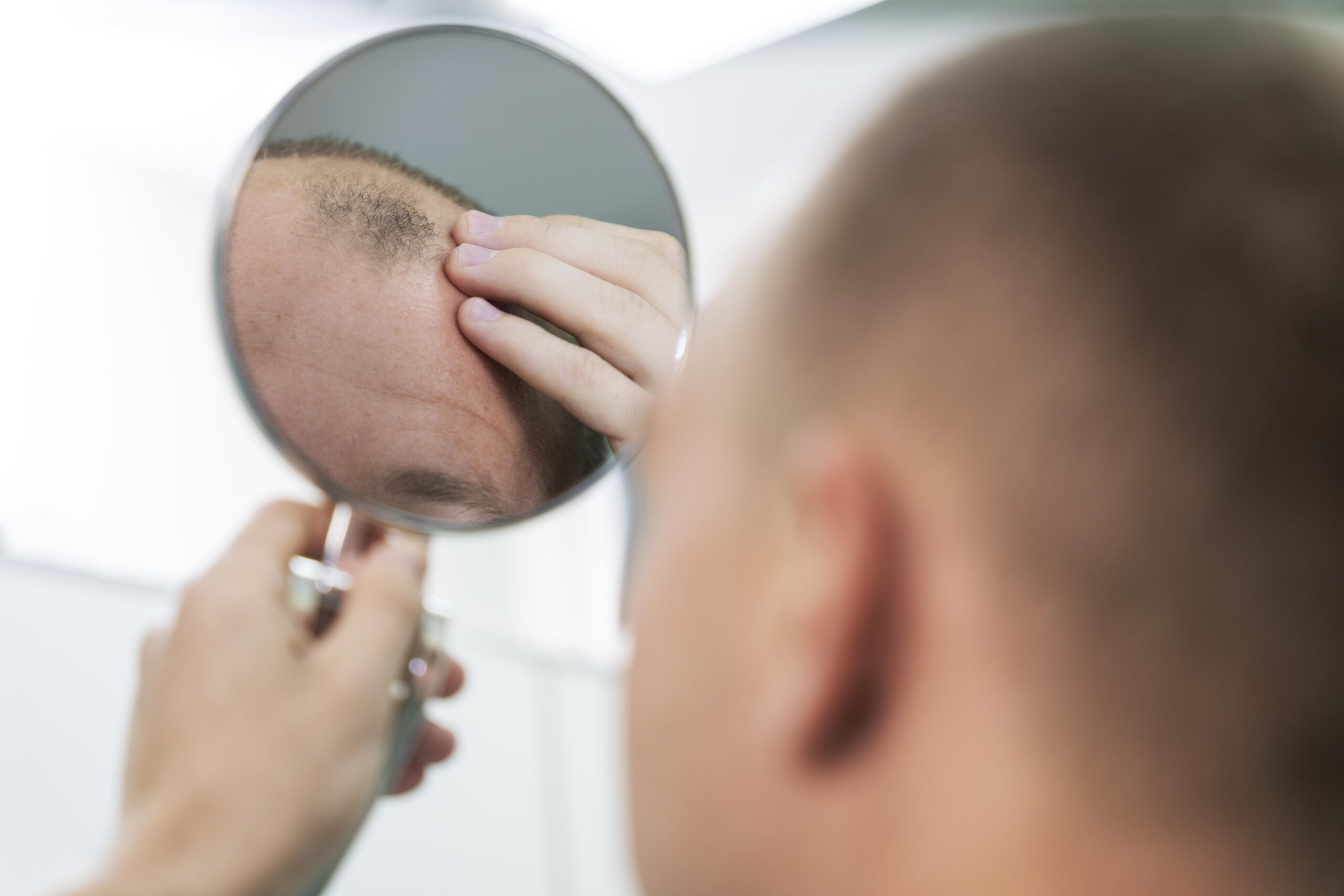 Baricitinib: la primera terapia para combatir la alopecia areata