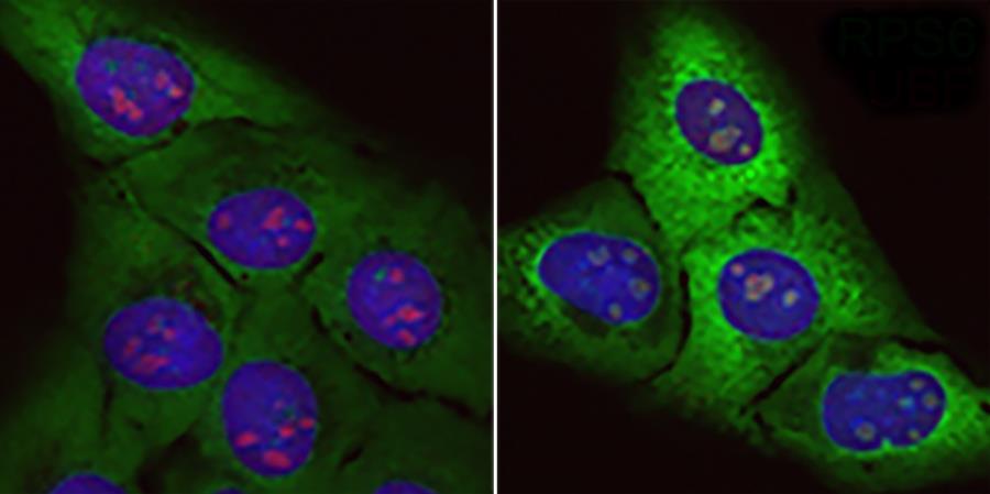 Identifican un posible origen de la esclerosis lateral amiotrófica