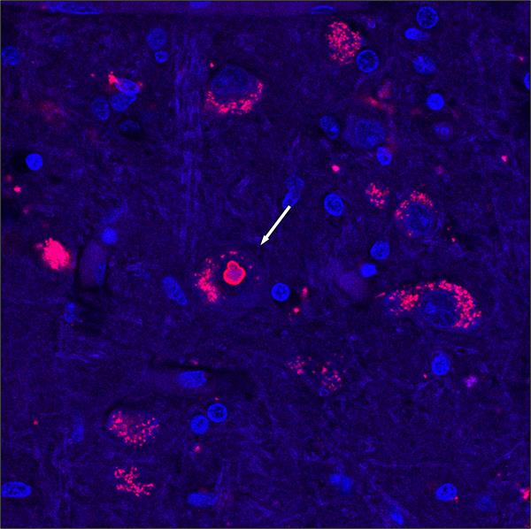 Descubren la causa de una rara enfermedad genética, hallazgo clave para futuras terapias