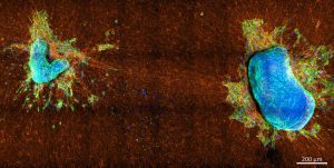 Un estudio arroja luz sobre la capacidad de las células cancerosas para migrar
