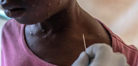 Mpox, una emergencia de salud pública internacional