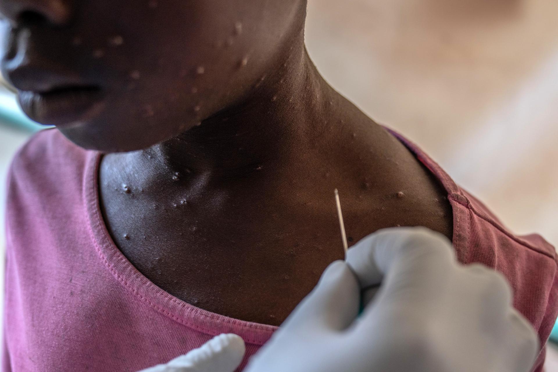 Mpox, una emergencia de salud pública internacional