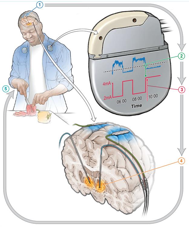 Un marcapasos cerebral personalizado reduce los síntomas en pacientes con parkinson