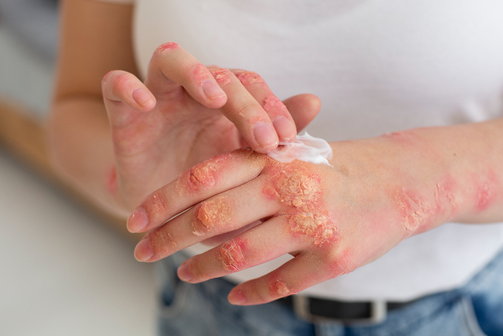 En España buscan mejorar las condiciones de personas con eczema crónico de manos