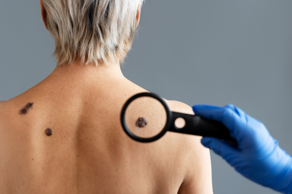 Los rayos UV causan 80% de los melanomas en el mundo