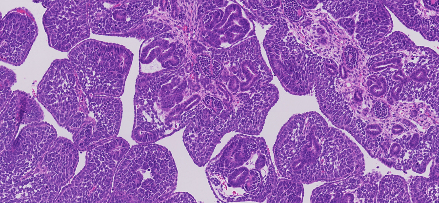 Alteraciones genéticas del cáncer renal infantil abren la puerta a nuevos tratamientos
