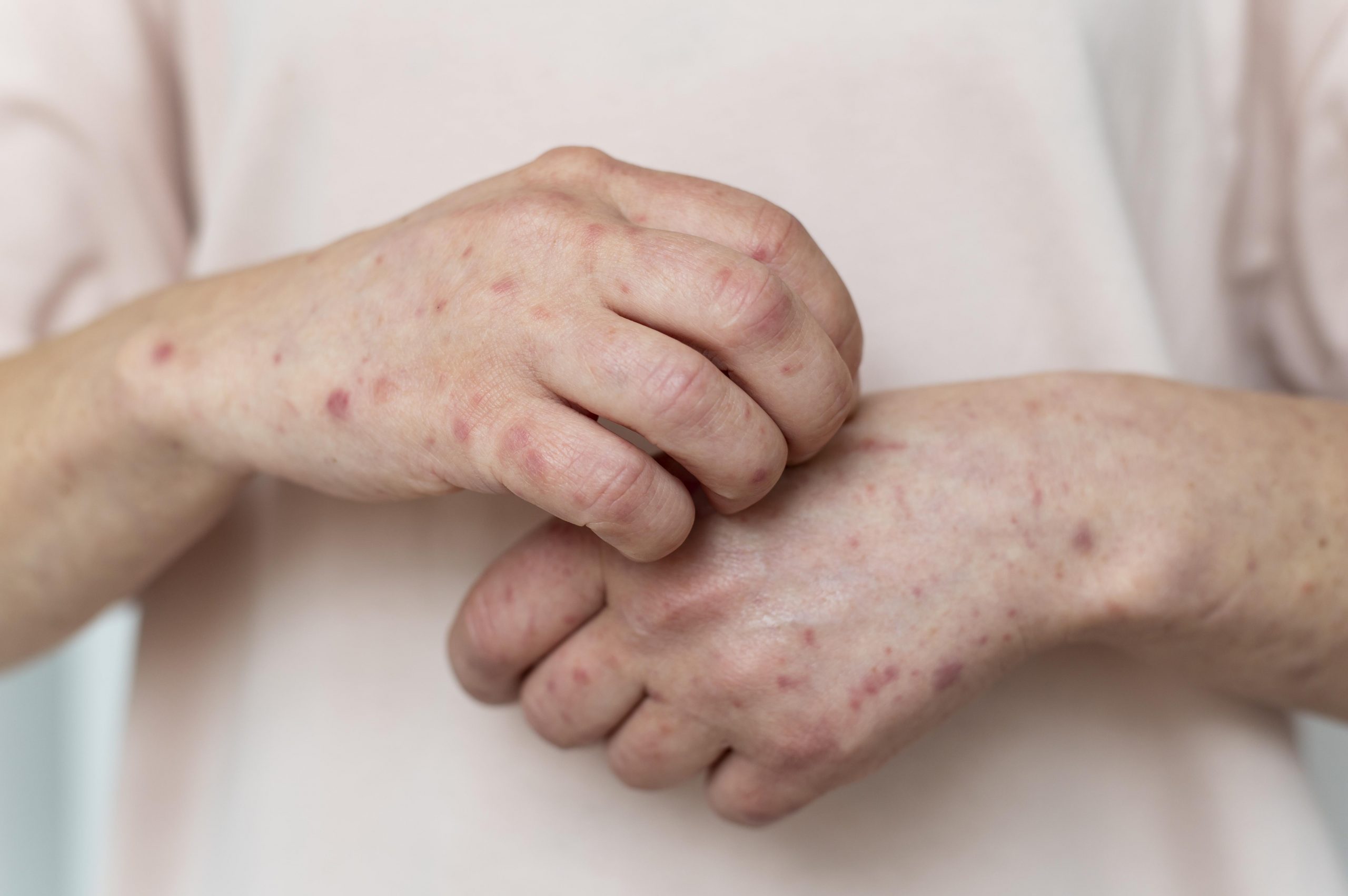 El sarampión, una enfermedad que puede prevenirse
