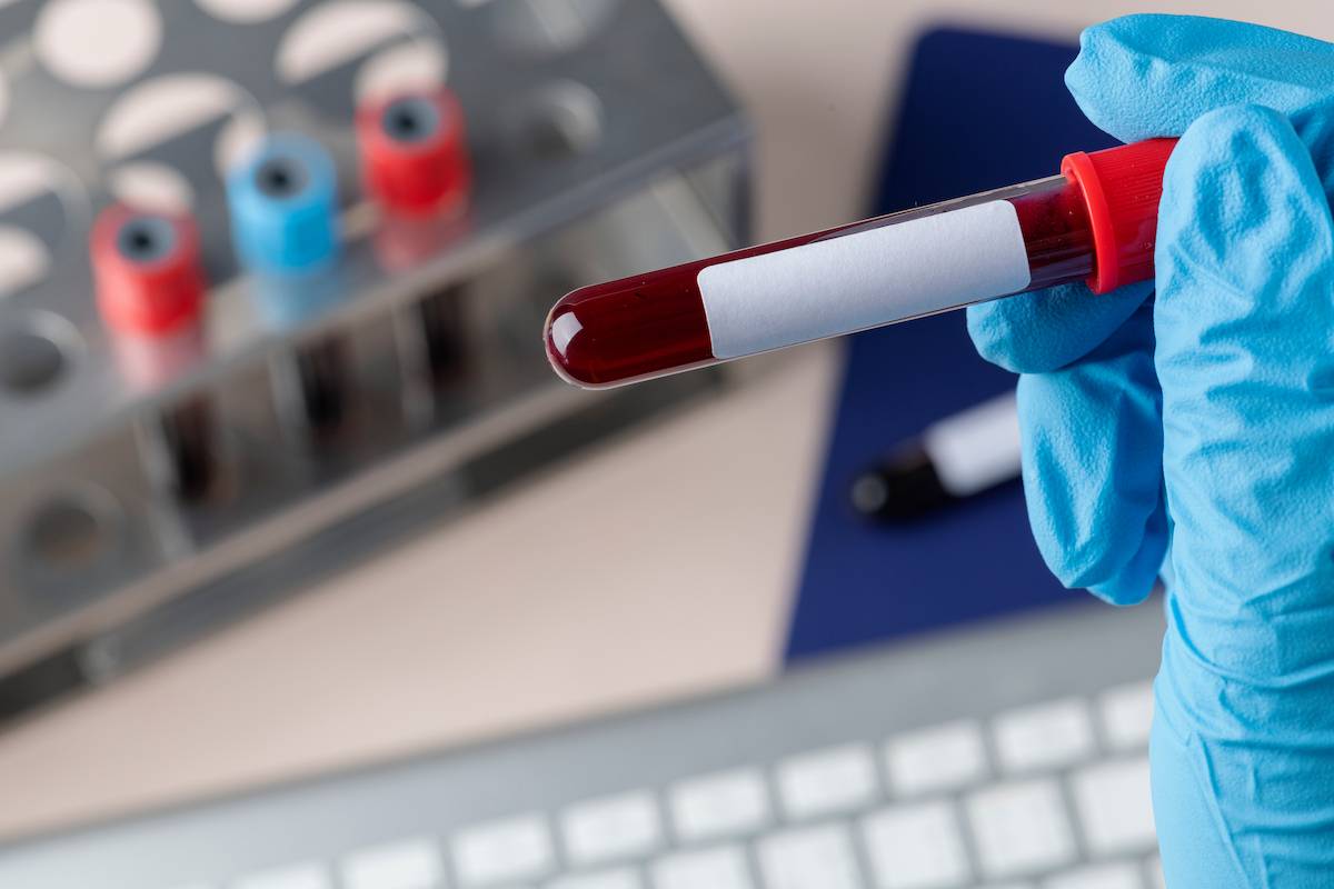Desarrollan una prueba que detecta tumores en estados iniciales en muestras de sangre