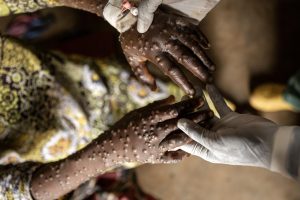 Patients treated in hospital amidst Congo’s mpox upsurge