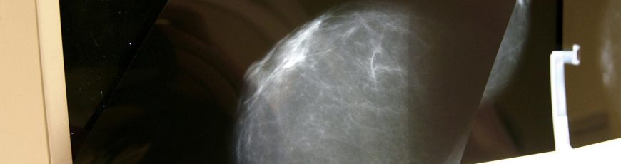 Relacionan la alta densidad mamaria con tumores de peor pronóstico
