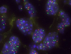 Una-proteina-actua-como-barrera-natural-frente-a-la-progresion-del-cancer-de-pulmon