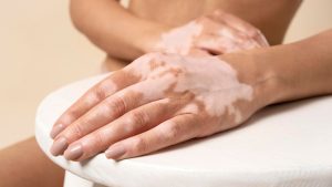 819-1-CIENCIA_Vitiligo_