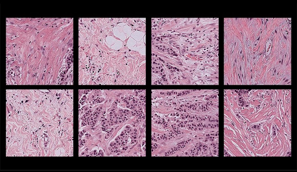 Imágenes patológicas de muestras de tejido humano. Crédito: El Atlas del Genoma del Cáncer