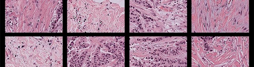 Una nueva herramienta reduce el sesgo de los análisis patológicos con IA