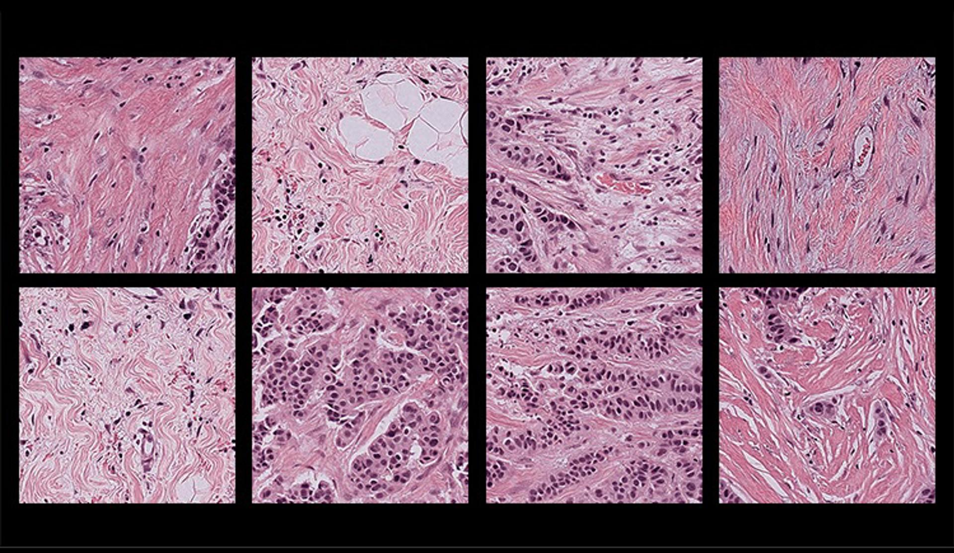 Una nueva herramienta reduce el sesgo de los análisis patológicos con IA