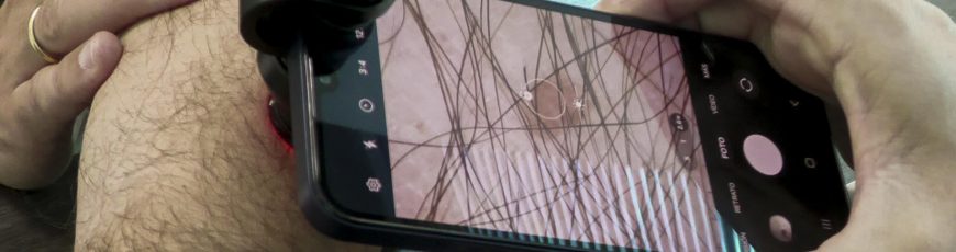 Científicos mexicanos investigan el desarrollo del cáncer de piel más común en el país