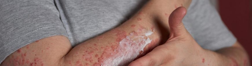 Descubren que un fármaco para la leucemia reduce los síntomas de la psoriasis