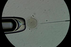 Detectan el primer caso de transmisión de una enfermedad rara mediante donante de esperma