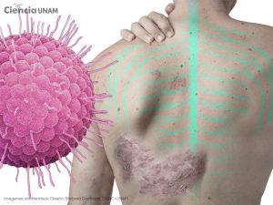 ar_herpes_zoster_01_04032026