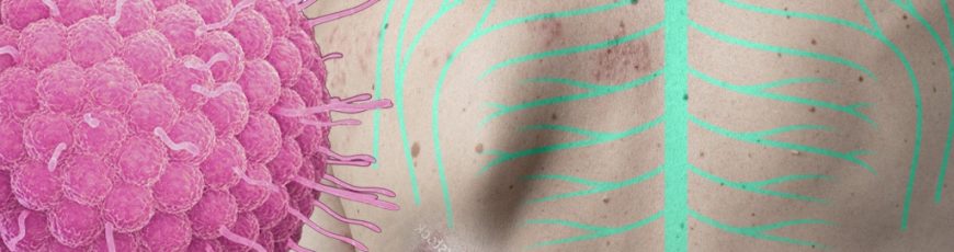 Herpes Zóster. El doloroso despertar del virus de la varicela