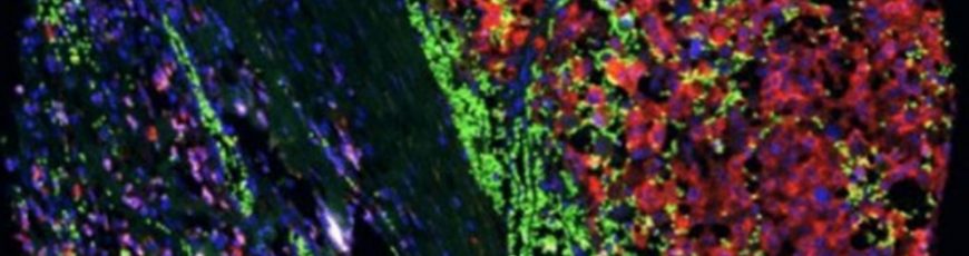 Una estrategia experimental reduce la metástasis del melanoma y mejora la inmunoterapia
