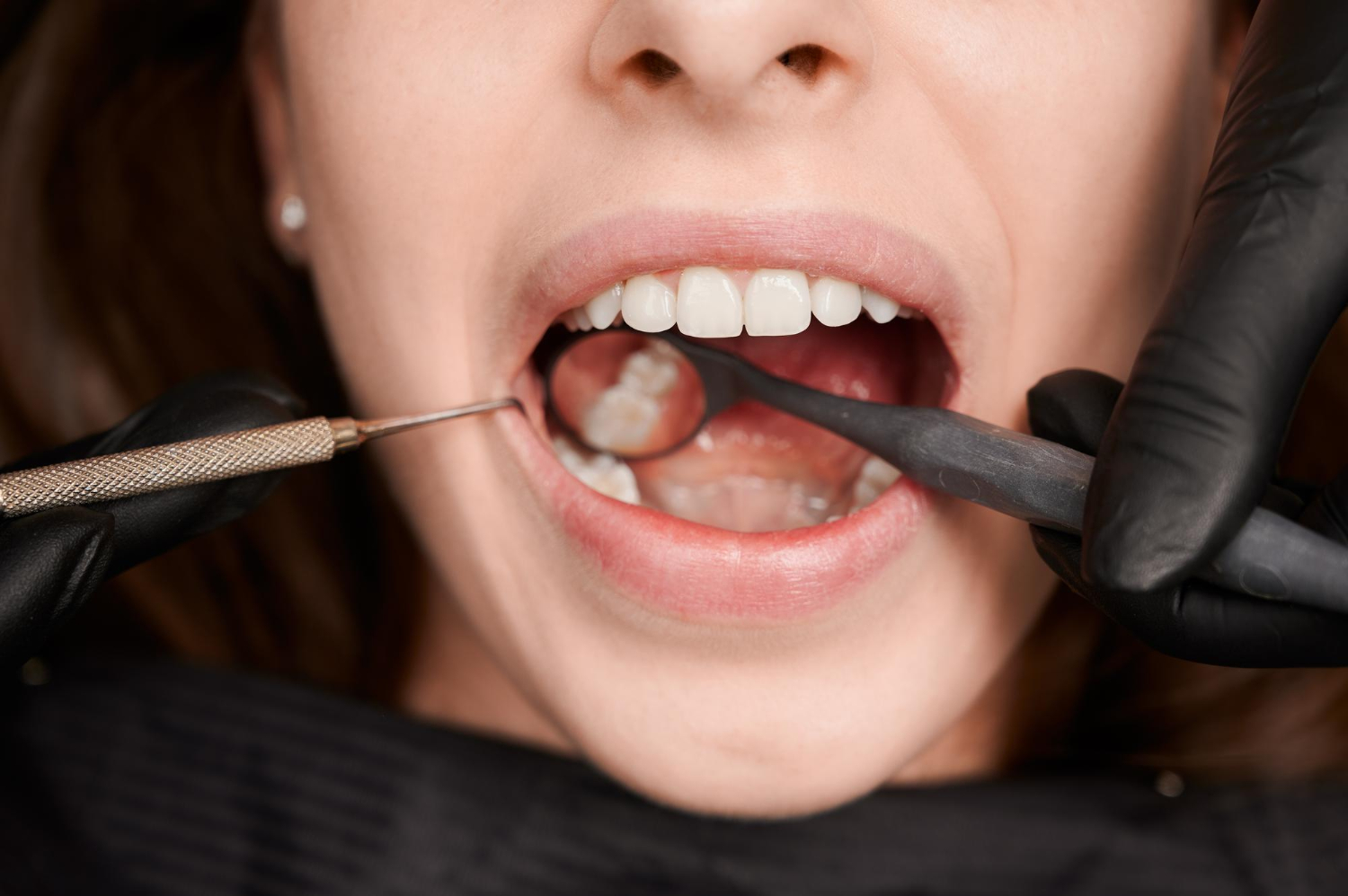 Signos y síntomas de la enfermedad periodontal