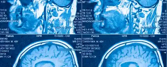 Identifican dos subtipos diferentes de autismo en el cerebro