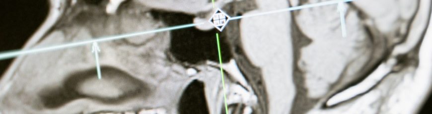 Desarrollan un implante que lee y modula el cerebro para tratar patologías nerviosas